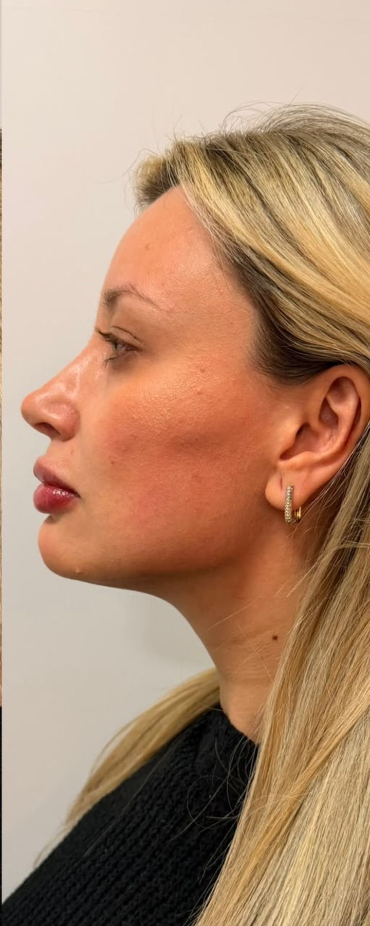 Depois — Full Face — projeção malar e refinamento do contorno